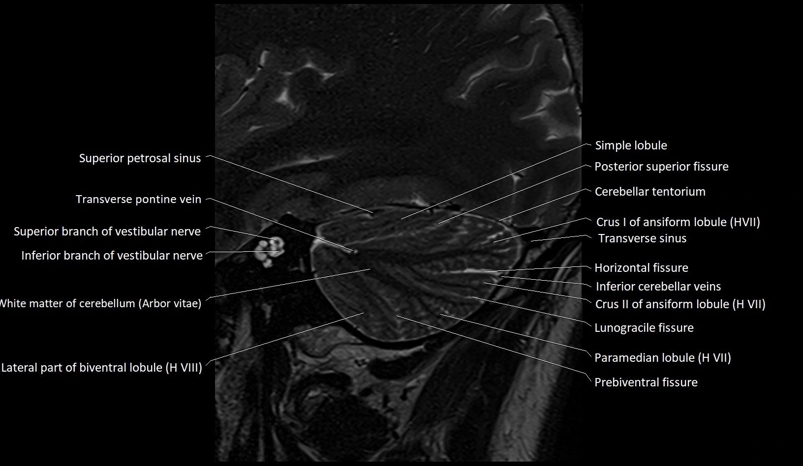 MRI Cerebellar anatomy sagittal High-resolution labelled image 12.webp